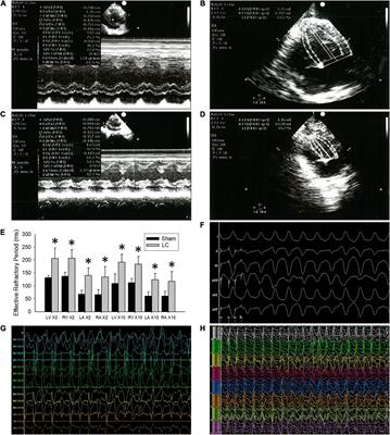 Evidence of Ventricular Arrhythmogenicity and Cardiac Sympathetic Hyperinnervation in Early Cirrhotic Cardiomyopathy